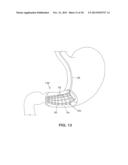 SATIATION DEVICES AND METHODS diagram and image