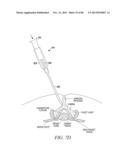 POWERED TISSUE MODIFICATION DEVICES AND METHODS diagram and image