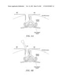 POWERED TISSUE MODIFICATION DEVICES AND METHODS diagram and image