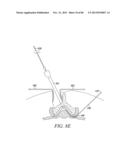 POWERED TISSUE MODIFICATION DEVICES AND METHODS diagram and image