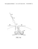 POWERED TISSUE MODIFICATION DEVICES AND METHODS diagram and image