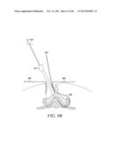 POWERED TISSUE MODIFICATION DEVICES AND METHODS diagram and image