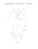 Combined Measured Resection Methods and Instruments for Knee Arthroplasty diagram and image