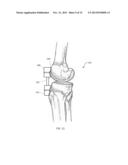 Combined Measured Resection Methods and Instruments for Knee Arthroplasty diagram and image