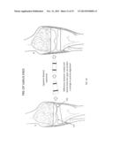 Combined Measured Resection Methods and Instruments for Knee Arthroplasty diagram and image