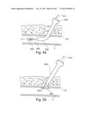 METHOD AND APPARATUS FOR PERCUTANEOUS TREATMENT OF A BLOOD VESSEL diagram and image
