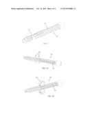 EXPANDABLE BONE FIXATION ELEMENT diagram and image