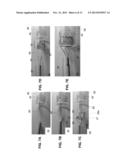 SYSTEM AND METHOD FOR ASSEMBLING A FOLDED PERCUTANEOUS VALVE diagram and image