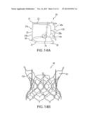 SYSTEM AND METHOD FOR ASSEMBLING A FOLDED PERCUTANEOUS VALVE diagram and image