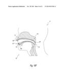 APPARATUS AND METHODS FOR THE TREATMENT OF SLEEP APNEA diagram and image