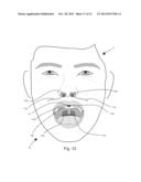 APPARATUS AND METHODS FOR THE TREATMENT OF SLEEP APNEA diagram and image