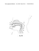 APPARATUS AND METHODS FOR THE TREATMENT OF SLEEP APNEA diagram and image