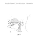 APPARATUS AND METHODS FOR THE TREATMENT OF SLEEP APNEA diagram and image