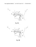 APPARATUS AND METHODS FOR THE TREATMENT OF SLEEP APNEA diagram and image