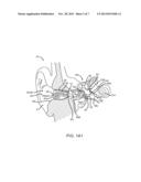 EARDRUM IMPLANTABLE DEVICES FOR HEARING SYSTEMS AND METHODS diagram and image