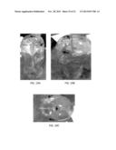 TRANSCRANIAL MAGNETIC STIMULATION FOR IMPROVED ANALGESIA diagram and image