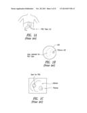 Percutaneous Magnetic Gastrostomy diagram and image