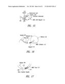 Percutaneous Magnetic Gastrostomy diagram and image