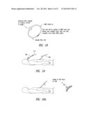 Percutaneous Magnetic Gastrostomy diagram and image