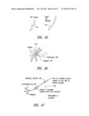 Percutaneous Magnetic Gastrostomy diagram and image