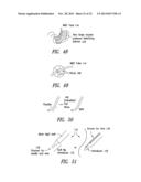 Percutaneous Magnetic Gastrostomy diagram and image