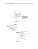 Percutaneous Magnetic Gastrostomy diagram and image