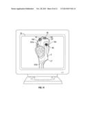 SOFT TISSUE CUTTING INSTRUMENT AND METHOD OF USE diagram and image