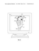 SOFT TISSUE CUTTING INSTRUMENT AND METHOD OF USE diagram and image