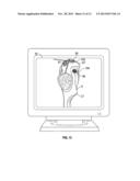 SOFT TISSUE CUTTING INSTRUMENT AND METHOD OF USE diagram and image