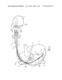 IMPLANTABLE CARDIOVERTER DEFIBRILLATOR DESIGNED FOR USE IN A MAGNETIC     RESONANCE IMAGING ENVIRONMENT diagram and image