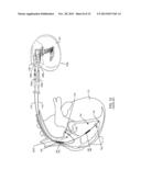 IMPLANTABLE CARDIOVERTER DEFIBRILLATOR DESIGNED FOR USE IN A MAGNETIC     RESONANCE IMAGING ENVIRONMENT diagram and image