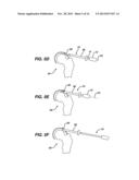 HIP OBTURATOR AND METHOD FOR ATRAUMATIC HIP ACCESS diagram and image