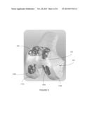 PATIENT-SPECIFIC INSTRUMENTATION AND METHOD FOR ARTICULAR JOINT REPAIR diagram and image