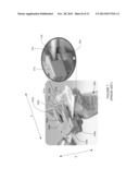 PATIENT-SPECIFIC INSTRUMENTATION AND METHOD FOR ARTICULAR JOINT REPAIR diagram and image