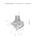 PATIENT-SPECIFIC INSTRUMENTATION AND METHOD FOR ARTICULAR JOINT REPAIR diagram and image