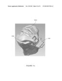 PATIENT-SPECIFIC INSTRUMENTATION AND METHOD FOR ARTICULAR JOINT REPAIR diagram and image