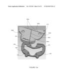 PATIENT-SPECIFIC INSTRUMENTATION AND METHOD FOR ARTICULAR JOINT REPAIR diagram and image