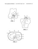 PATIENT-SPECIFIC JOINT ARTHROPLASTY DEVICES FOR LIGAMENT REPAIR diagram and image