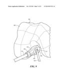 PATIENT-SPECIFIC JOINT ARTHROPLASTY DEVICES FOR LIGAMENT REPAIR diagram and image