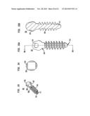 METHODS FOR STABILIZING BONE USING SPINAL FIXATION DEVICES diagram and image