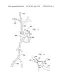 VARYING DIAMETER VASCULAR IMPLANT AND BALLOON diagram and image