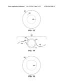 APPARATUS FOR CREATING INCISIONS TO IMPROVE INTRAOCULAR LENS PLACEMENT diagram and image