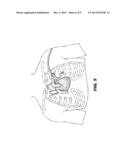 METHOD AND DEVICE FOR PERCUTANEOUS LEFT VENTRICULAR RECONSTRUCTION diagram and image