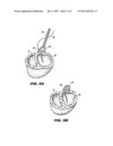 METHOD AND DEVICE FOR PERCUTANEOUS LEFT VENTRICULAR RECONSTRUCTION diagram and image