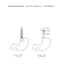 DEVICES AND METHODS FOR GASTROINTESTINAL BYPASS diagram and image