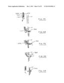 DEVICES AND METHODS FOR GASTROINTESTINAL BYPASS diagram and image