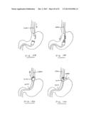 DEVICES AND METHODS FOR GASTROINTESTINAL BYPASS diagram and image