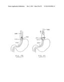 DEVICES AND METHODS FOR GASTROINTESTINAL BYPASS diagram and image