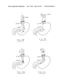 DEVICES AND METHODS FOR GASTROINTESTINAL BYPASS diagram and image