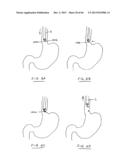 DEVICES AND METHODS FOR GASTROINTESTINAL BYPASS diagram and image